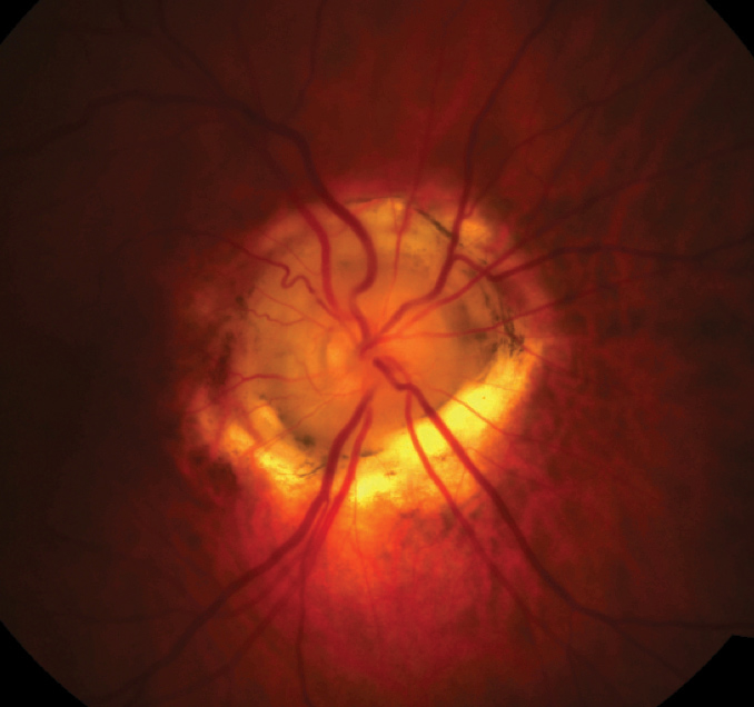 MGDA may cause an irregular optic nerve pattern in patients. Photo: Nevi Hehar, OD. 