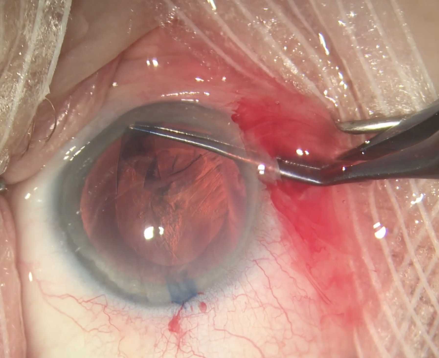 COVID-19 has caused a decrease in many ophthalmic procedures. Photo: Christina Tran, BS, and Leonid Skorin, Jr., DO, OD. 