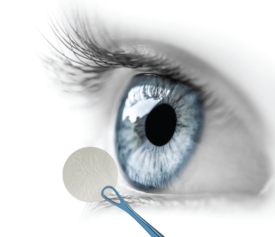 Amniotic membrane is enlarged and darkened to show detail. Photo: Akorn Eye Care. 