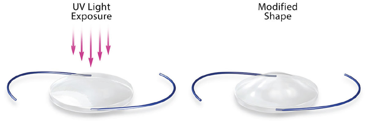 RxSight’s Light Adjustable Lens (LAL) is composed of UV light–sensitive polymers. An advantage to LALs is that ODs have the ability to adjust the lens postoperatively. 