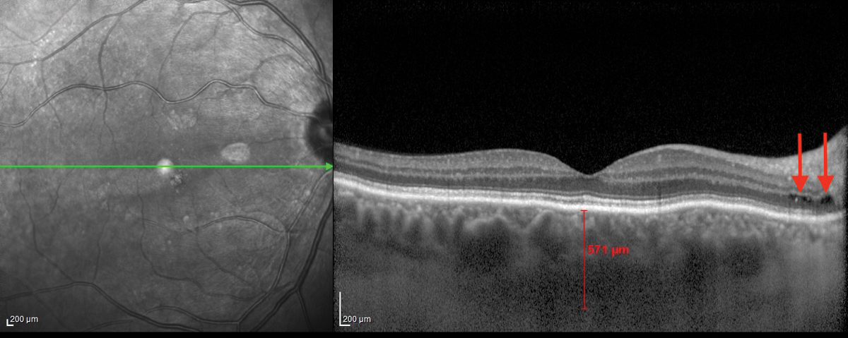 Researchers found the choroid of more myopic eyes to be thicker than less myopic eyes. Note: Image is not from a patient in the study. Photo: Jim Williamson, OD, Meagan Williams, OD. 