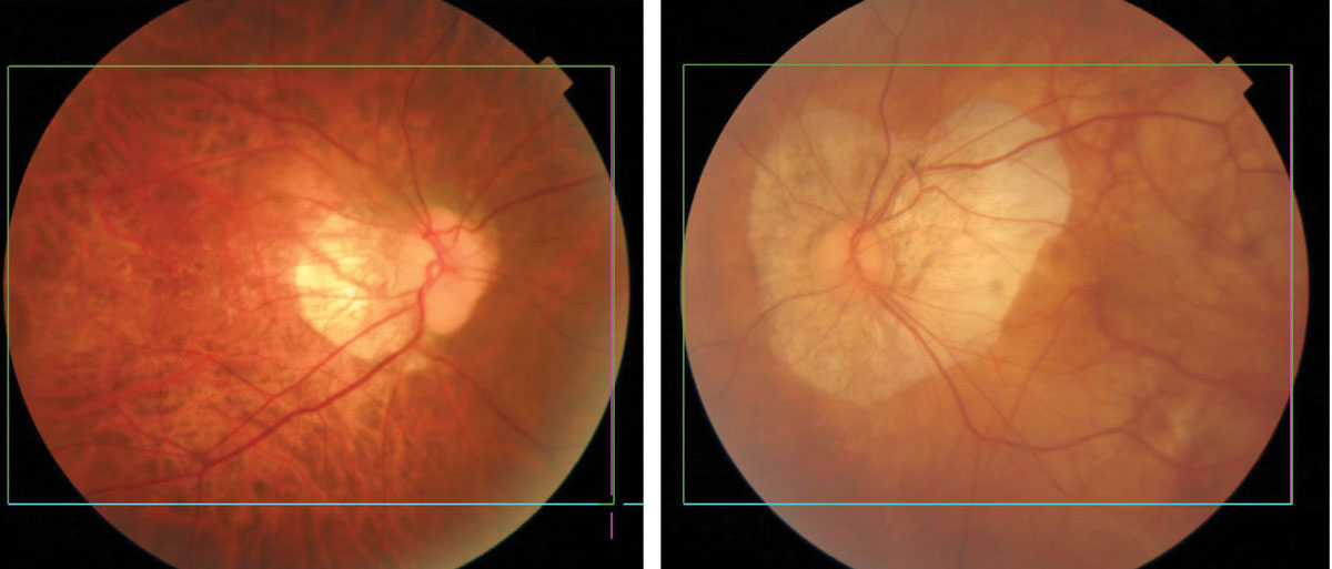 Myopic degeneration showing thinning and atrophy of the posterior pole. Eyes of Asian patients have more pigment (left) than eyes of Caucasians (right).