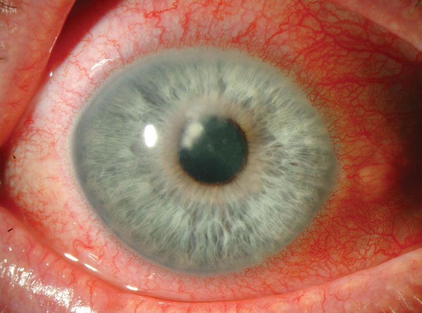 Astigmatism and scar size each mediated 23% of the effect of crosslinking on BSCVA.