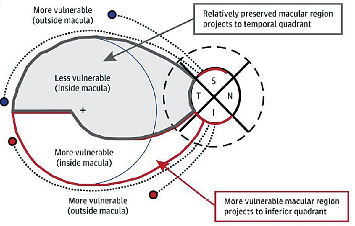 Fig. 5. This illustration demonstrates the inferior vulnerability zone, which consists of macular fibers that are at risk for damage due to glaucoma. The superior vulnerability zone does not consist of macular fibers.