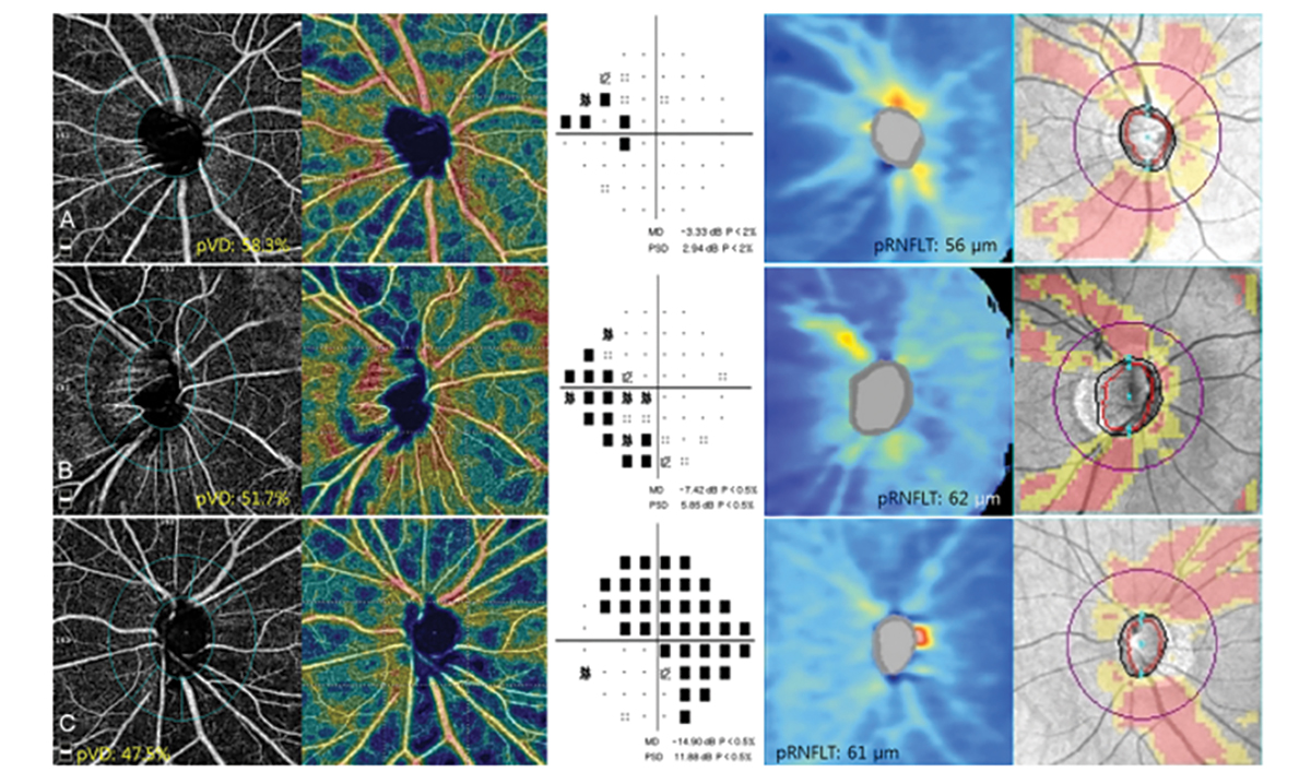 Fig. 6. This image shows the OCT-A scans of peripapillary vessel density, visual field scans and OCT RNFL scans of three different patients. The peripapillary vessel density loss correlated more to the visual field defect than to the OCT RNFL scan.
