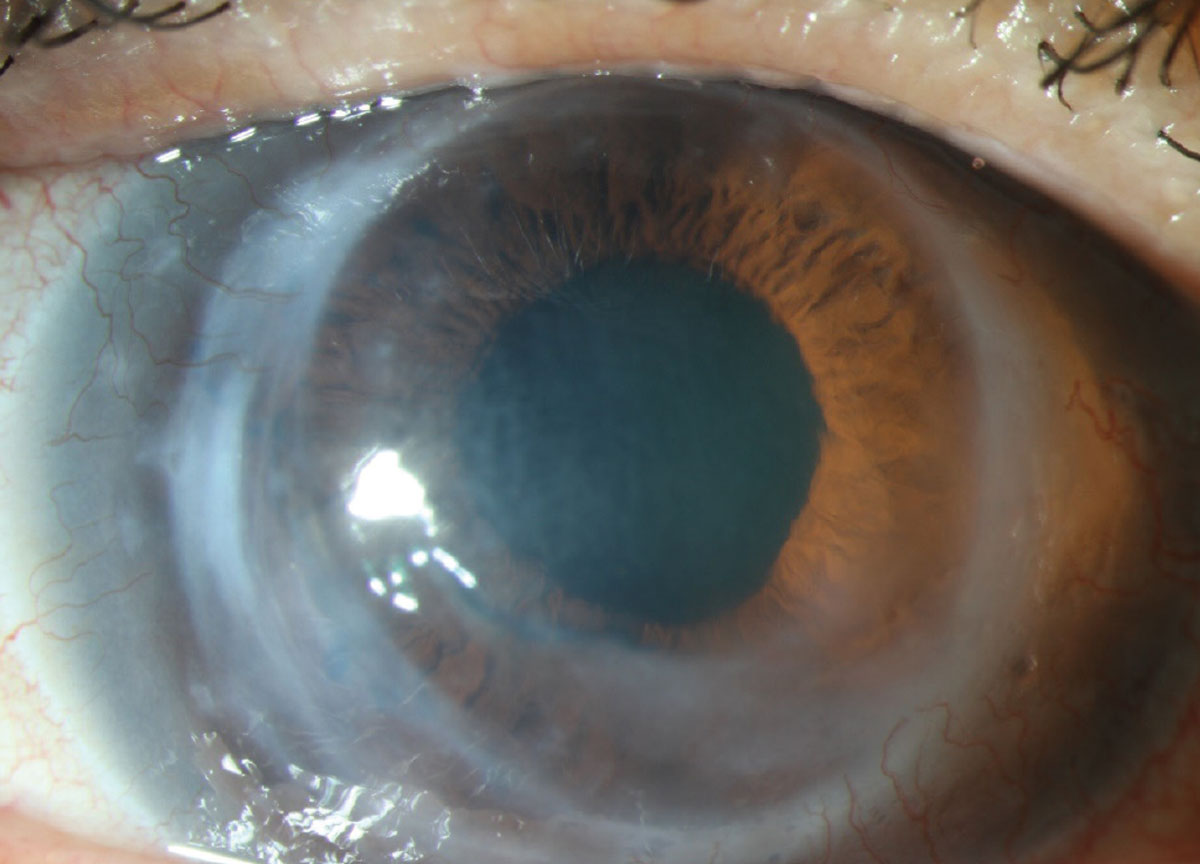 Fig. 1. Corneal ectasia in a graft performed 36 years prior for keratoconus.