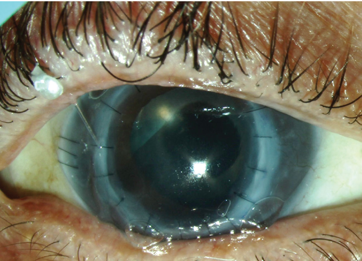 Fig. 2. Repeat corneal transplantation and cataract extraction performed with area of ectasia removed.