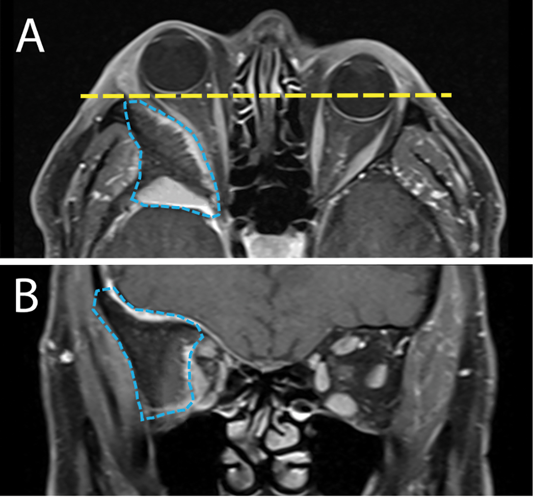 Fig. 3. A: Axial MRI orbit study reveals a large intraosseous lesion of the greater wing of the sphenoid bone (blue line). The mass resulted in right globe proptosis (yellow line). B: Coronal MRI view reveals the extensive bony lesion (blue line) causing significant orbital volume loss and medialization of all orbital content.
