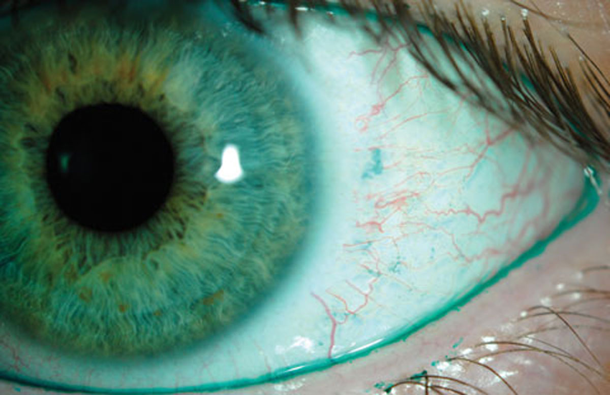 Depression and anxiety may be linked to dry eye.