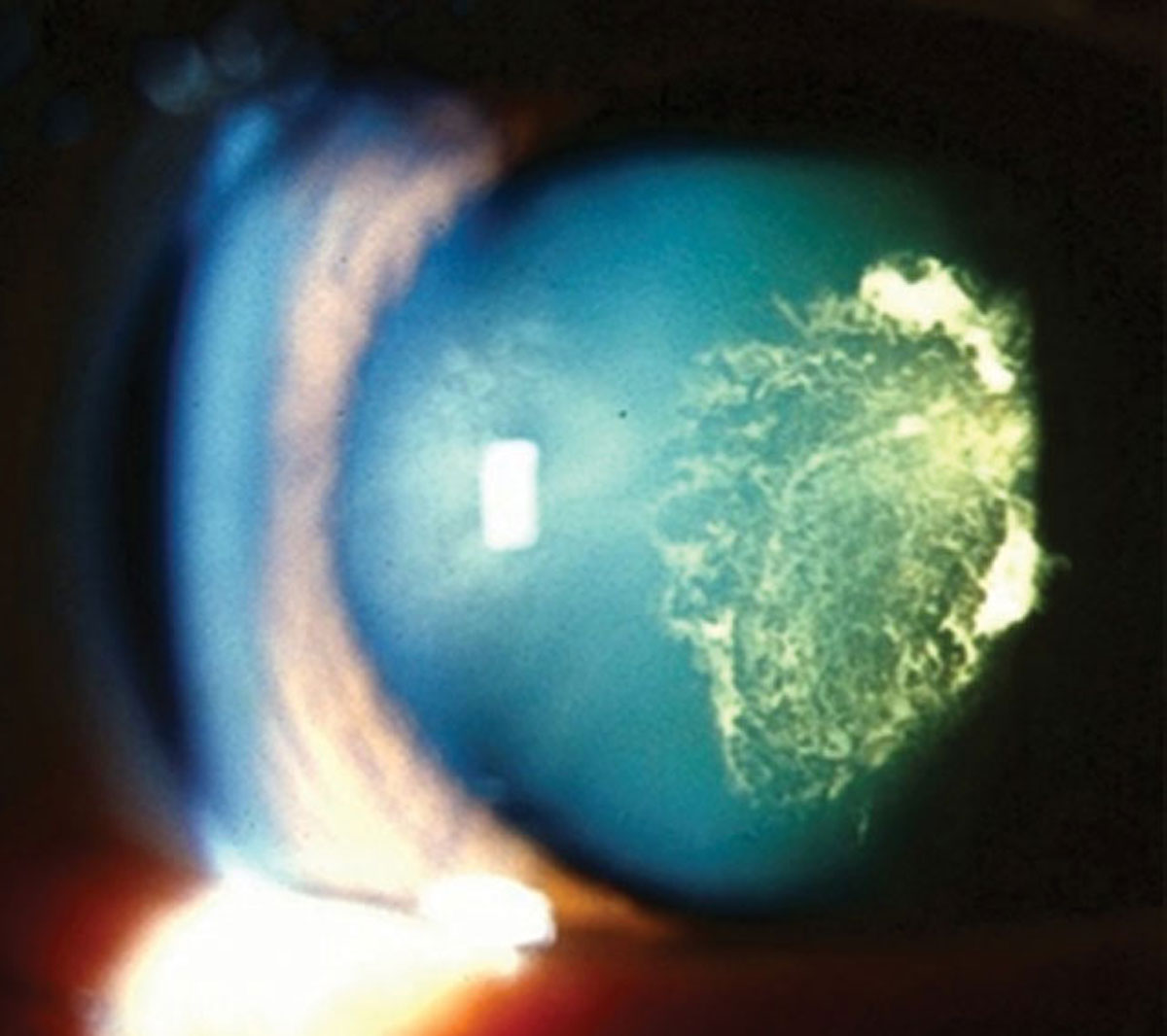Deep learning helps quantitatively classify cataract severity. 