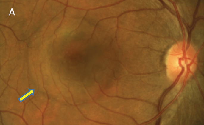 According to data in this study, patients with CSC have a higher rate of AMD development.