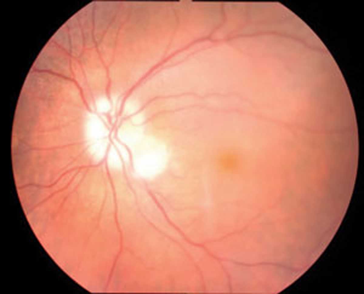 The combination of retinal angiography and MRI allows for accurate diagnosis of GCA.