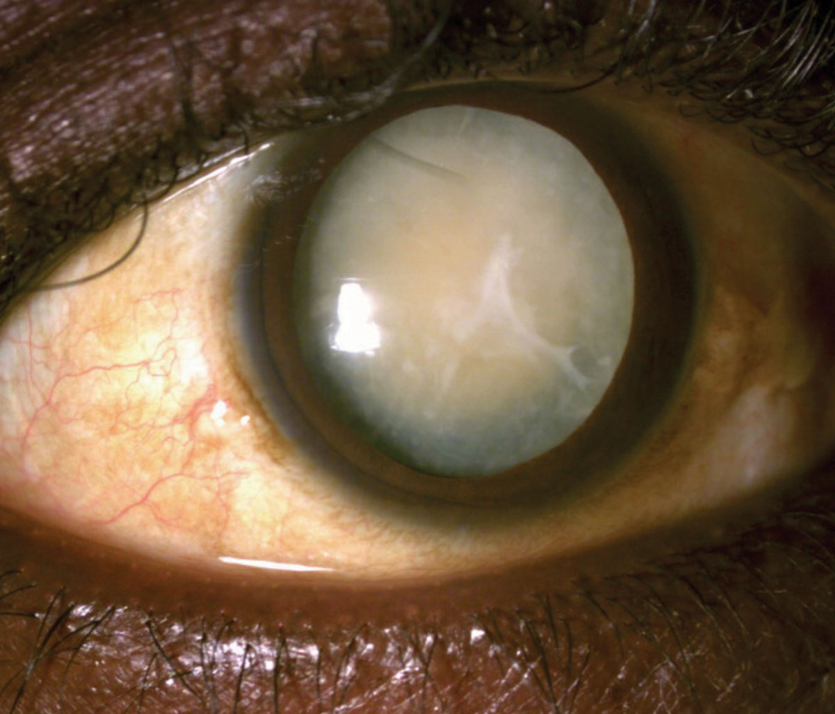 Nearly a third of eyes had intraocular pathologies after mature cataract surgery in this study. 