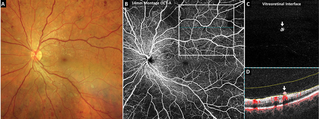 Using a classification model that included both retinal and choroidal microvasculature helped better identify DR in patients in this study.