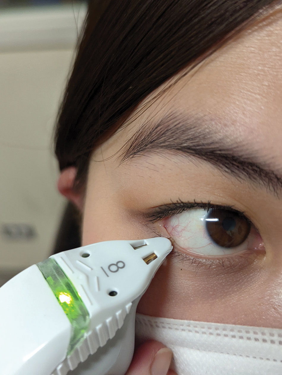 This patient was tested using a tear osmolarity system and the result showed elevated osmolarity level of 312 mOsm/L. It is important not to manipulate the lid while taking the sample.