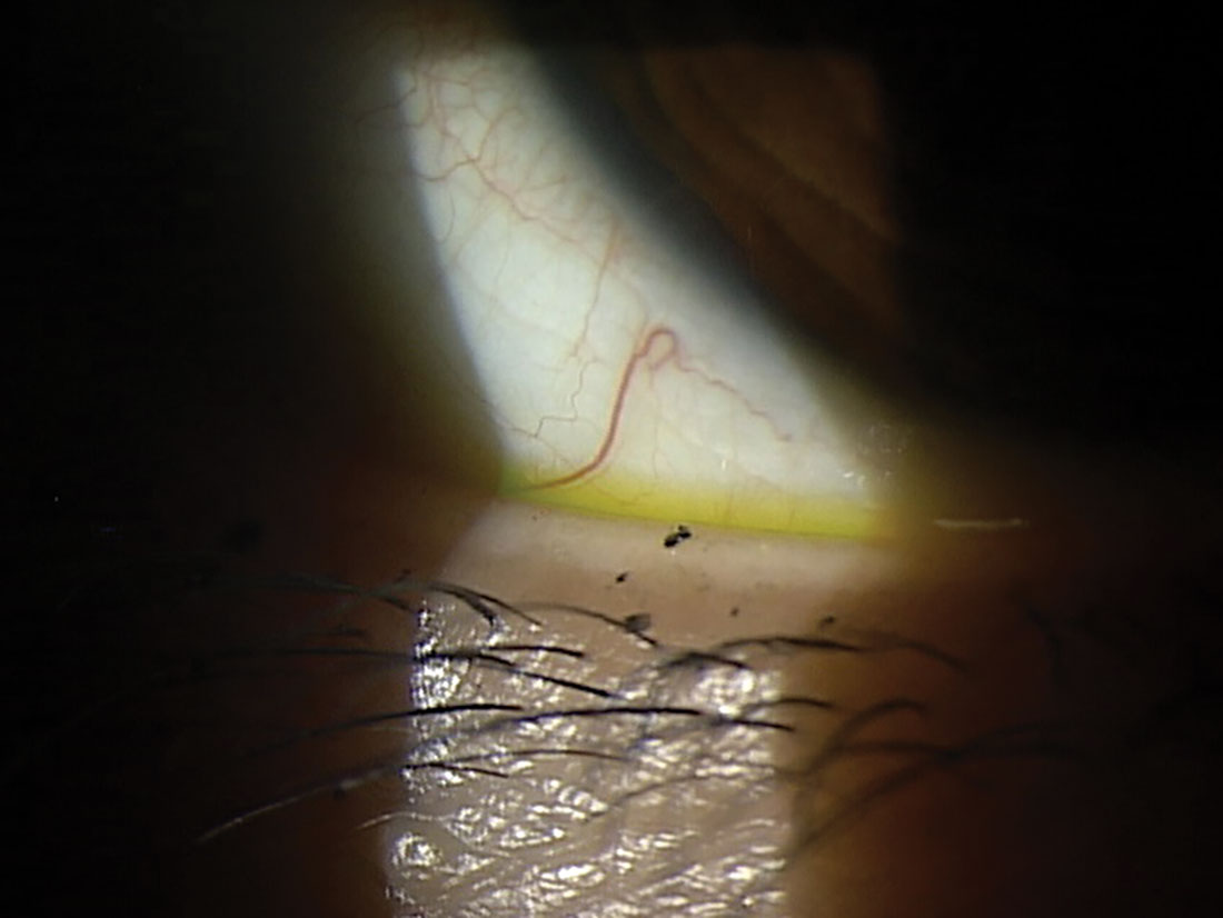 This patient’s tear meniscus is highlighted by the addition of NaFI. A cobalt blue filter can also assist with visualization. This patient has an adequate tear meniscus, but their ocular surface symptoms are exacerbated by makeup debris and systemic medications.
