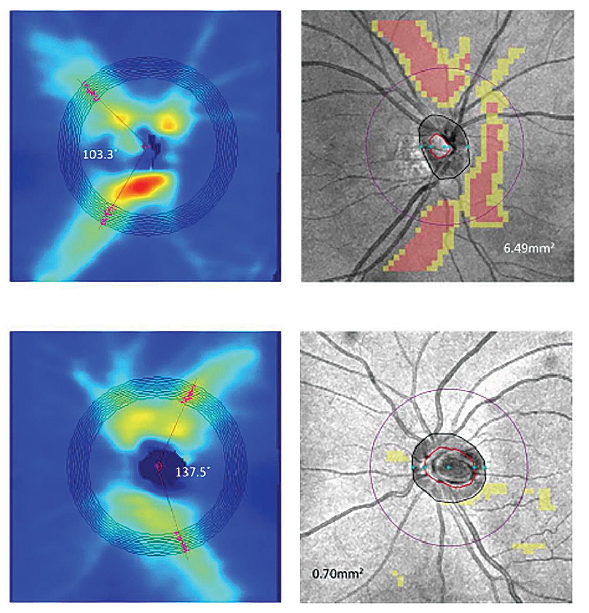 RNFL thickness (left) and deviation maps (right) show the increased vulnerability to glaucoma brought about by high myopia. The top images are a -6.75D myopia with an axial length of 27.26mm; at bottom is a -2.00D myopia with axial length of 26.61mm.