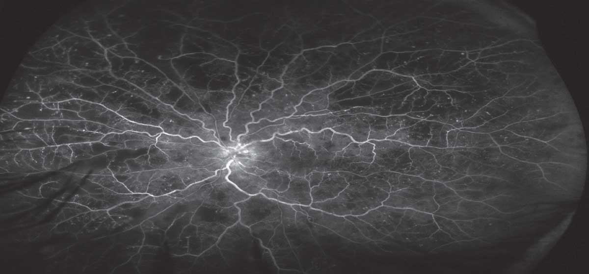 This later-stage widefield fluorescein angiography (FA) in a patient with an ischemic central retinal vein occlusion shows several areas of capillary dropout, which were targeted with panretinal photocoagulation (PRP).