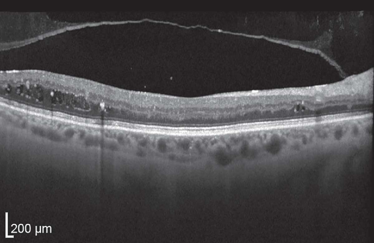 This OCT shows non-center-involving but not visually significant diabetic macular edema (non-CI, NVS DME) with intraretinal fluid and exudates. This would qualify as CSDME per the ETDRS. 