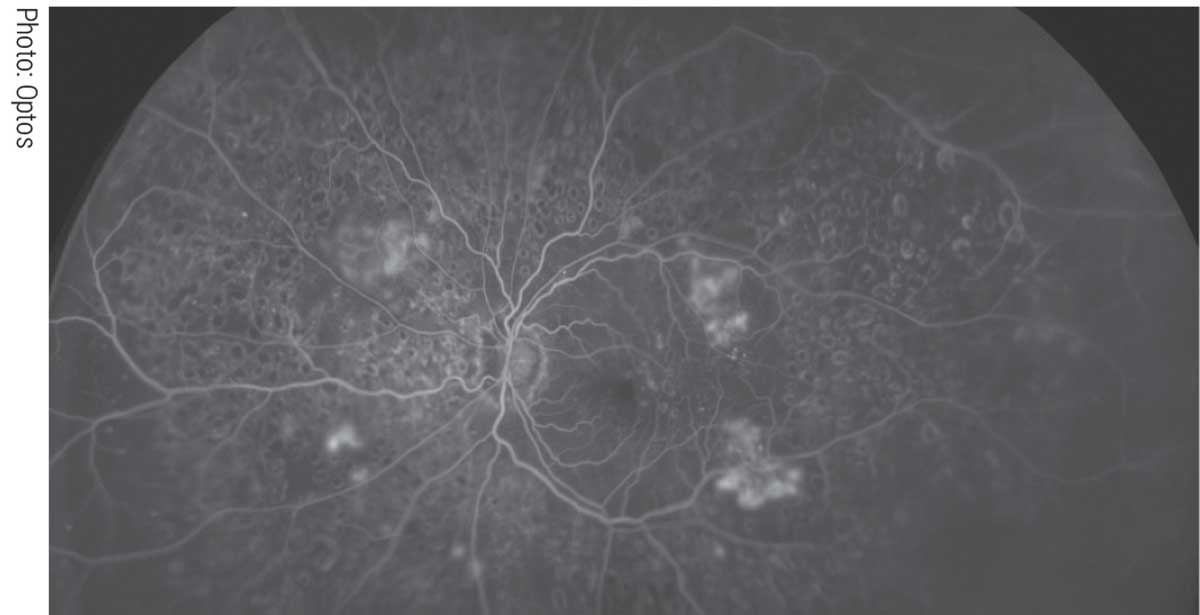 Ultra-widefield imaging’s expansive views of the retina highlight the shortcomings of conventional diabetic retinopathy staging.