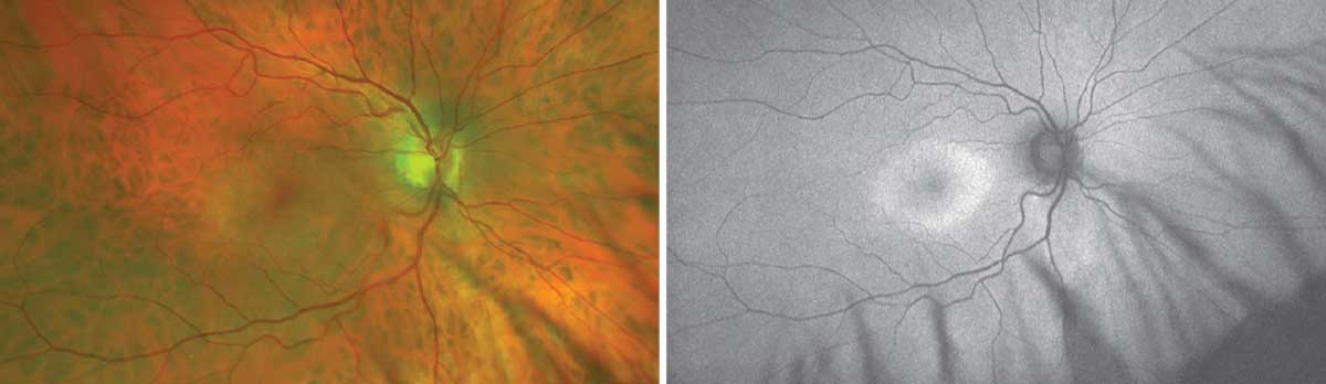 Optos photo showing parafoveal outer retinal and RPE atrophy and FAF imaging showing parafoveal hyper-AF of classic bull’s-eye maculopathy seen in Plaquenil toxicity. 