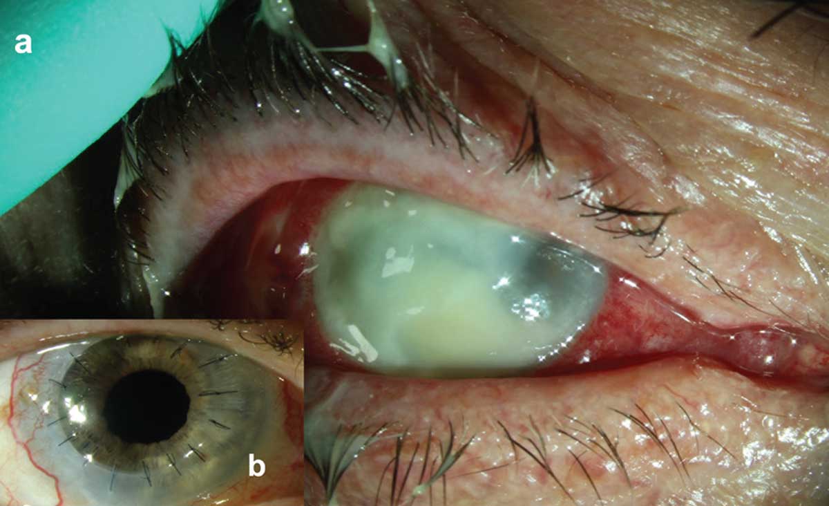 Pseudomonas keratitis with associated stromal necrosis and hypopyon and early involvement of superotemporal scleral tissue (a). Clean and compact corneal graft with intact corneal epithelium and quiet ocular surface (b).