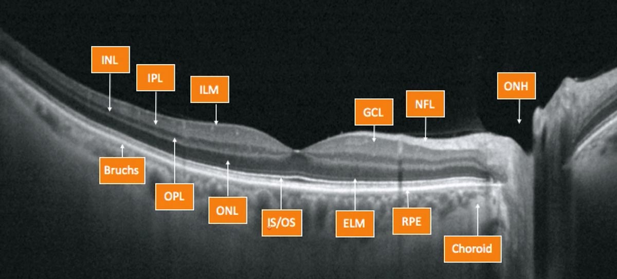 Macular OCT may be a beneficial tool for cataract surgery assessment.