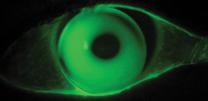 Apical bearing by a rigid lens in keratoconus has been shown to induce epithelial thinning.