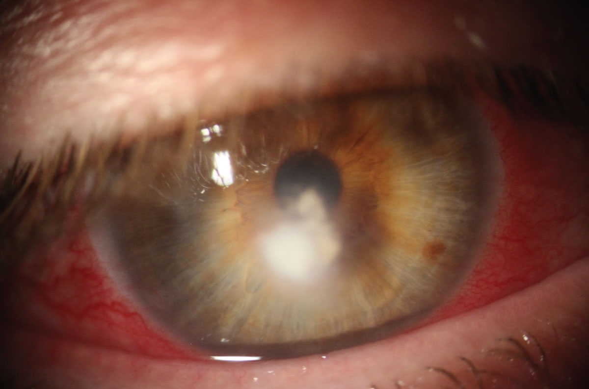 Fungal keratitis (shown here in a different patient) likely developed from malnutrition.