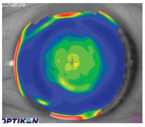 Center-near lenses may be a good option for presbyopes, study shows.
