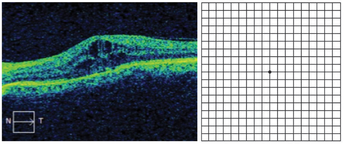 Amsler grid eye test for detecting macular problems