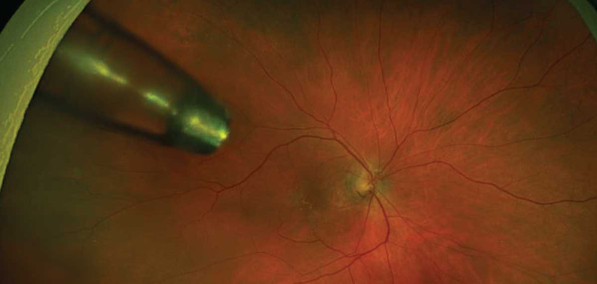 Fig. 4. Ultra-widefield image of wet AMD patient treated with the Susvimo implant.