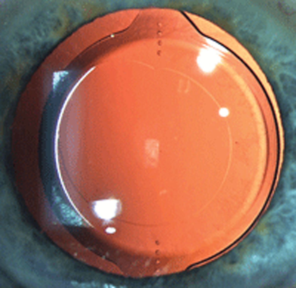 Predicted refractive astigmatism was shown to effectively aid in cataract surgery evaluation and determination of potential IOL outcomes.