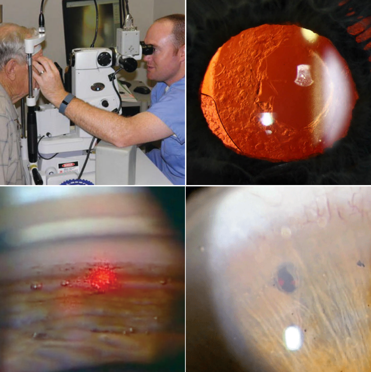 ODs in Virginia can now perform three types of laser surgery