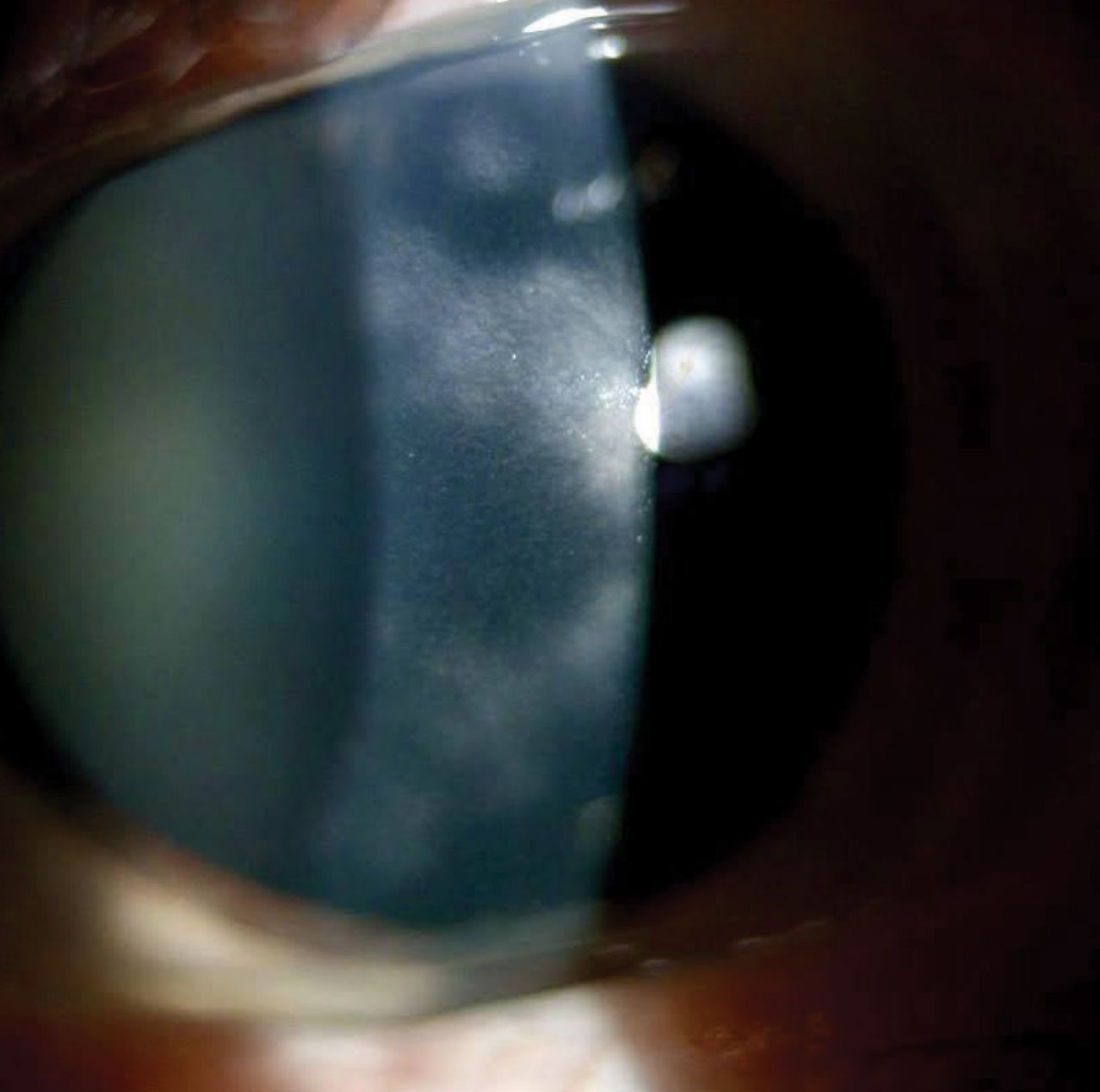 Case 1. This patient’s cornea showed diffuse patches of intrastromal haze.