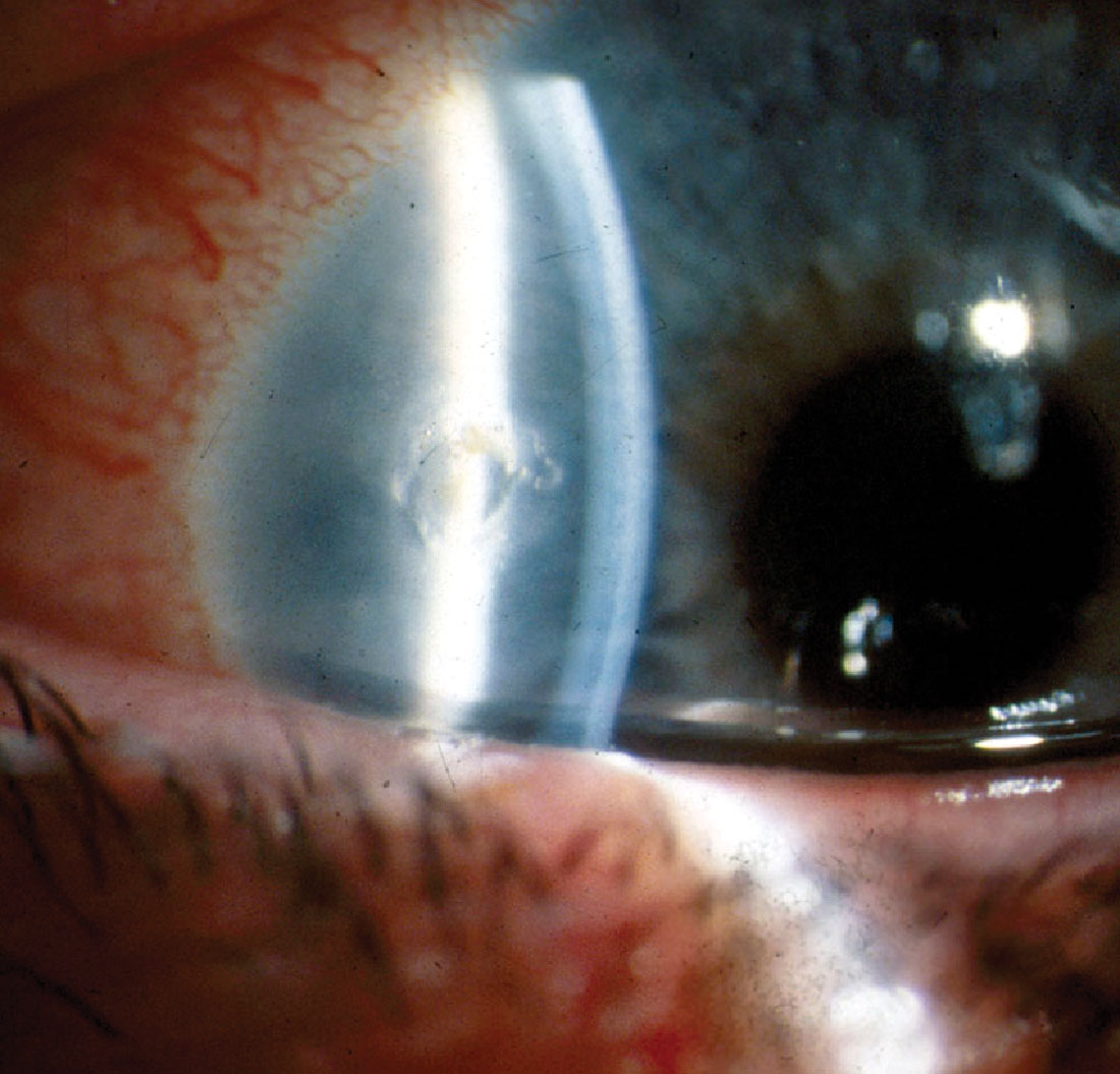 Fig. 6. Corneal epithelial defect immediately following foreign body removal with an Algerbrush.