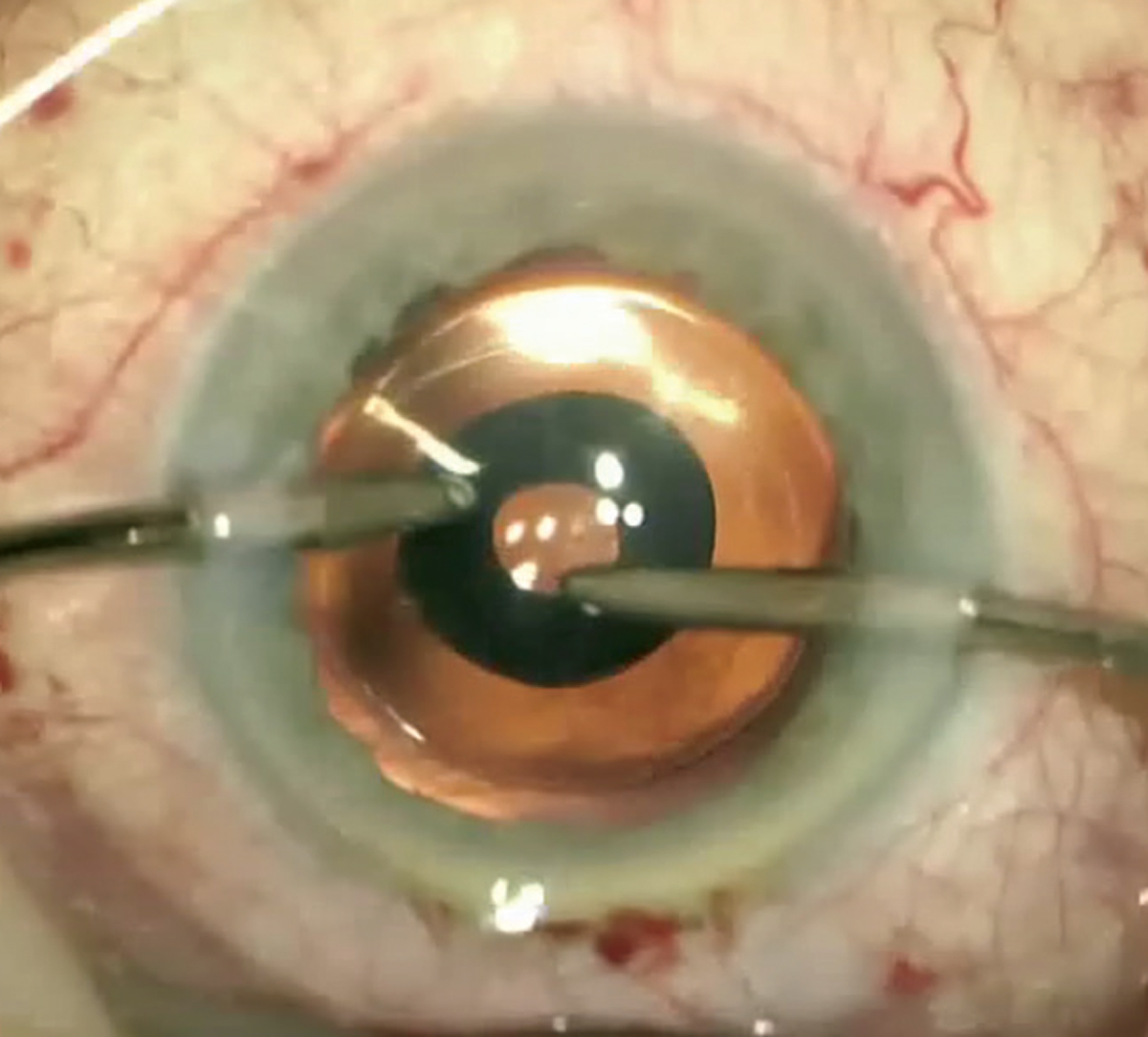 The mini-ring in the center of the IC-8 IOL extends a patient’s depth of focus.