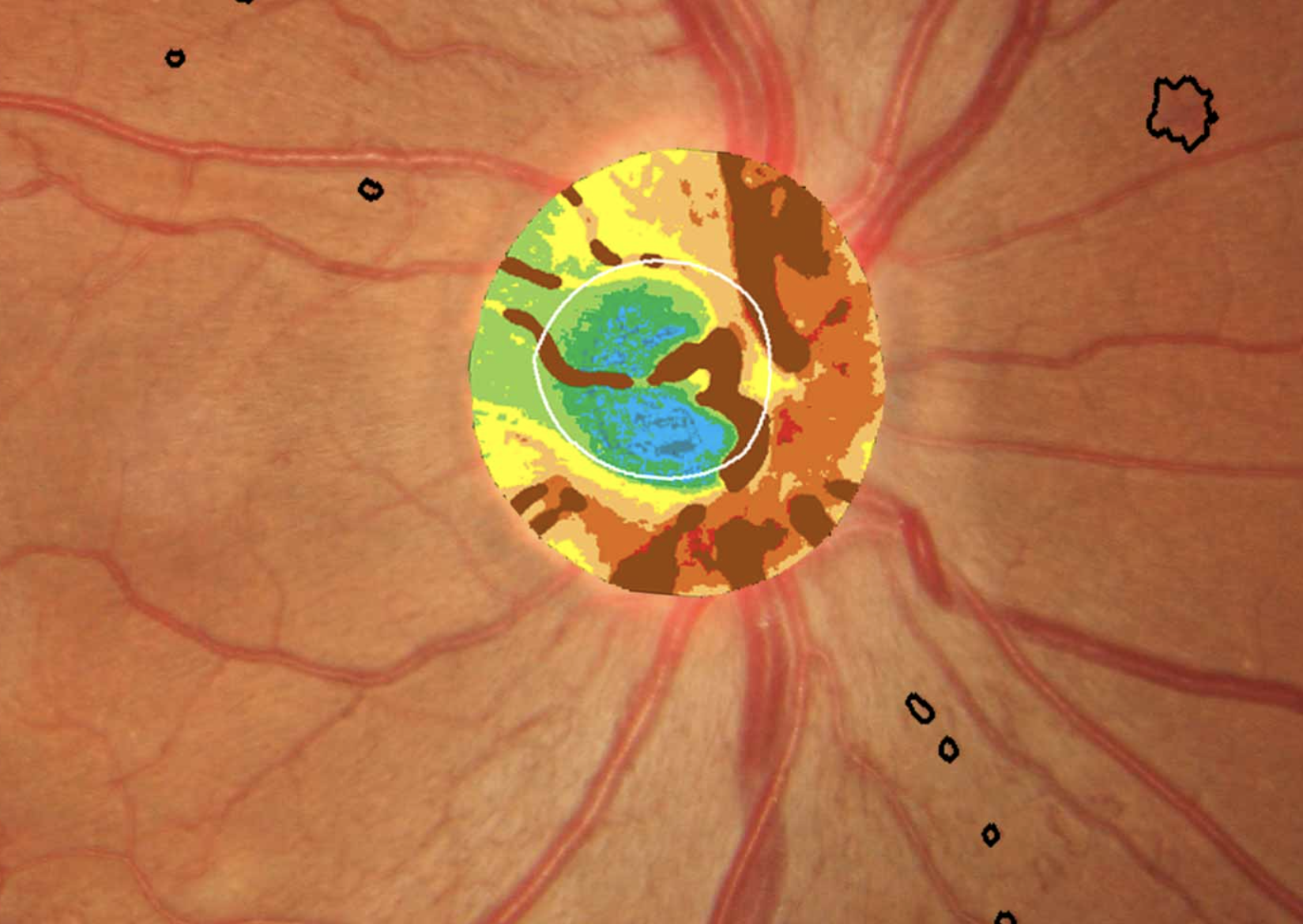 Measuring the hemoglobin concentration in the optic nerve head may aid in glaucoma diagnosis.