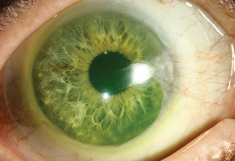 Scleral lens thickness didn't seem to have an effect on corneal edema risk in this study.
