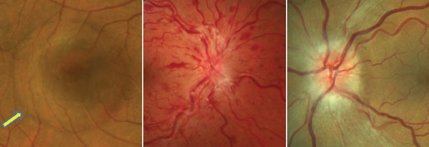 Study finds elevated risks of (L to R) serous retinal detachment, retinal vein occlusion and ischemic optic neuropathy in patients using ED drugs. 