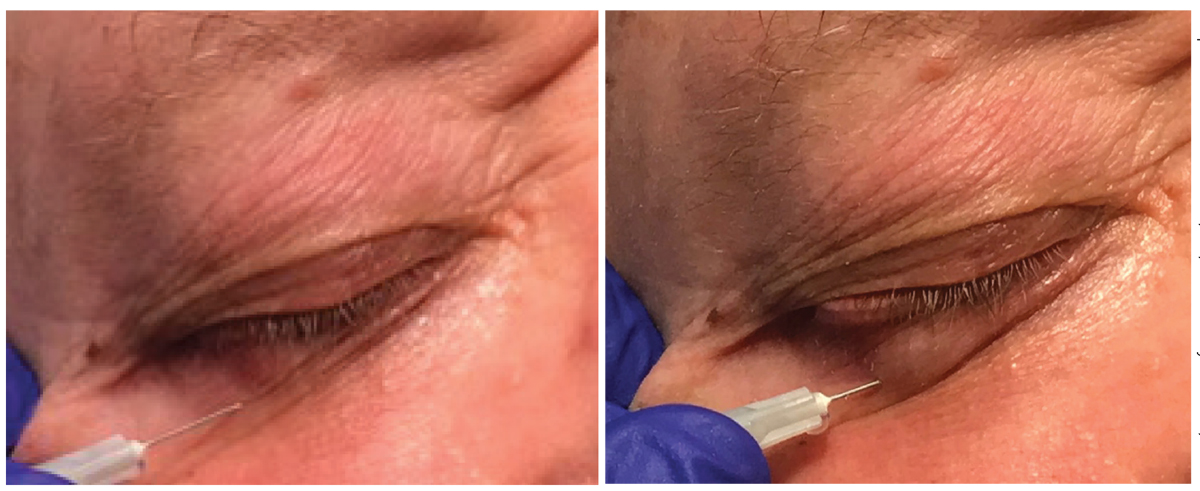 On the left, a patient receives an injection of lidocaine prior to removal of a lesion on the palpebral conjunctiva. On the right is the same patient immediately after injection with the bolus of anesthetic visible under the skin.