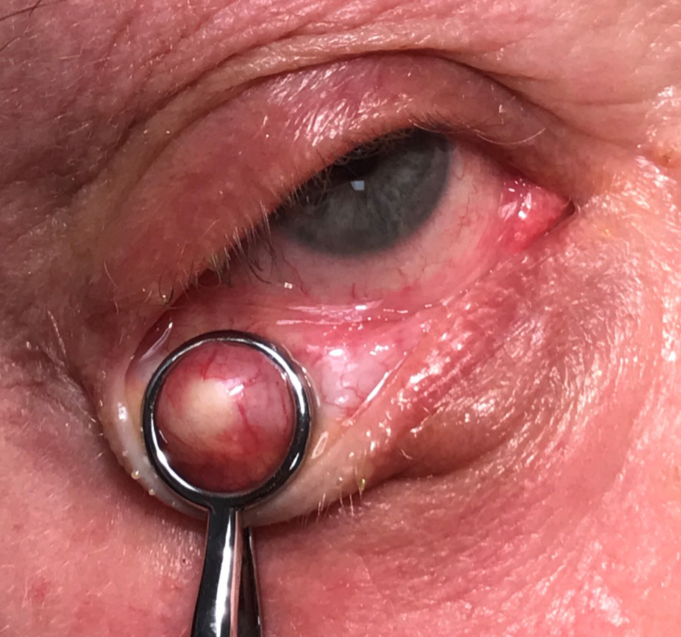 Before you perform the incision/curettage, the chalazion should be clamped to prevent the mass from moving during the procedure.