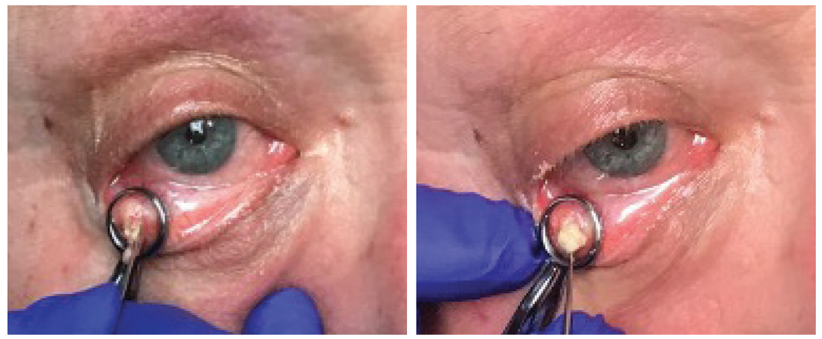 The left image shows granulomatous material extruding from the palpebral conjunctival lesion upon incision. On the right, curettage of the chalazion is expelling the material.