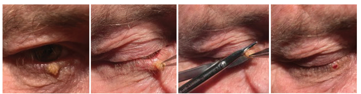 From left to right: Squamous papilloma pre-op; isolation of papilloma using forceps to expose the base; surgical scissors are used to snip the lesion at its base; immediately after lesion removal with snip excision. Note the minimal amount of blood seen in the last image.