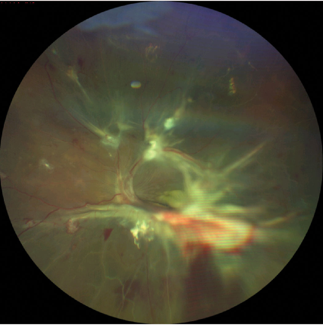 Severe neovascularization with hemorrhage and fibrous proliferation in diabetic retinopathy, leading to tractional retinal detachment.