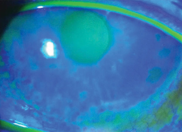 The dry eye cohort in this study treated with rhNGF eye drops experienced significant symptom improvement, and researchers believe it could be a promising therapy for this population.