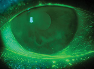 Patients with severe vitamin D deficiencies were found to have worse conjunctival parameters.
