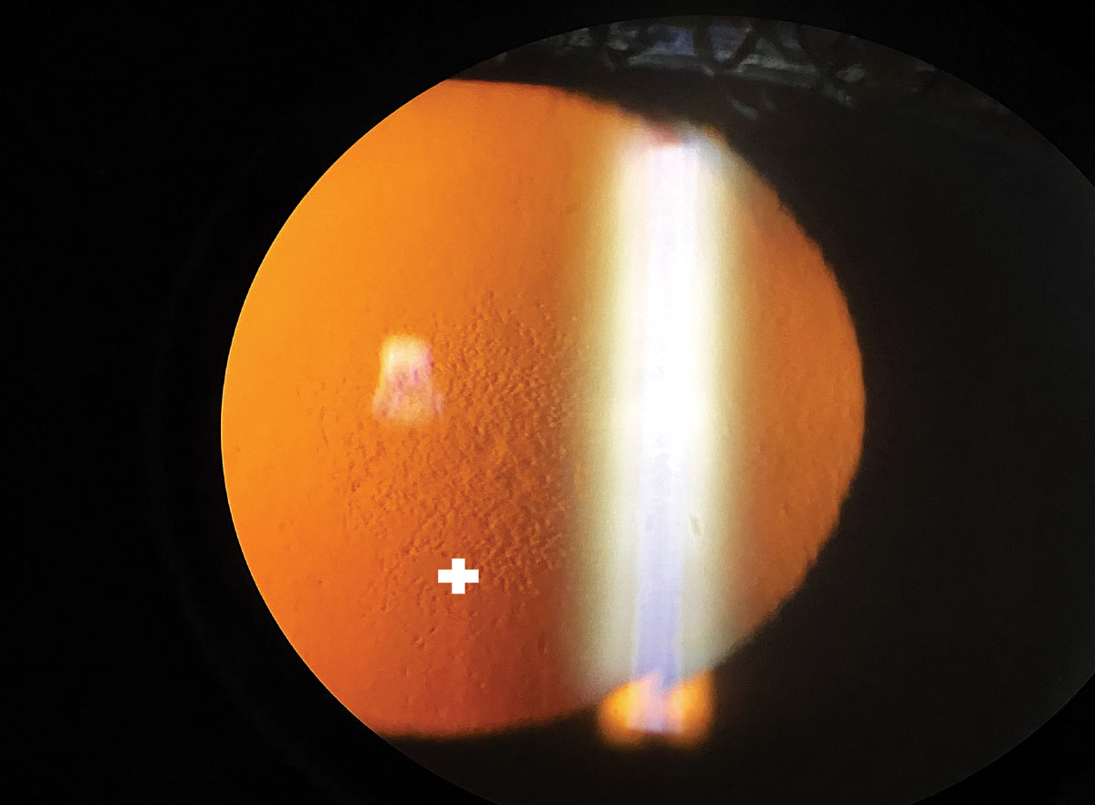 Occasionally, donor corneas may be positive for corneal guttata; however,  this study observed that most cases are mild and don't affect graft survival rate.