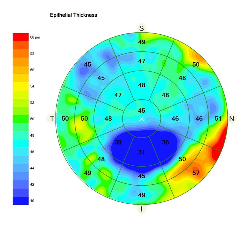 Researchers found that corneal and epithelial thickness maps are an accurate way to detect and diagnose keratoconus.