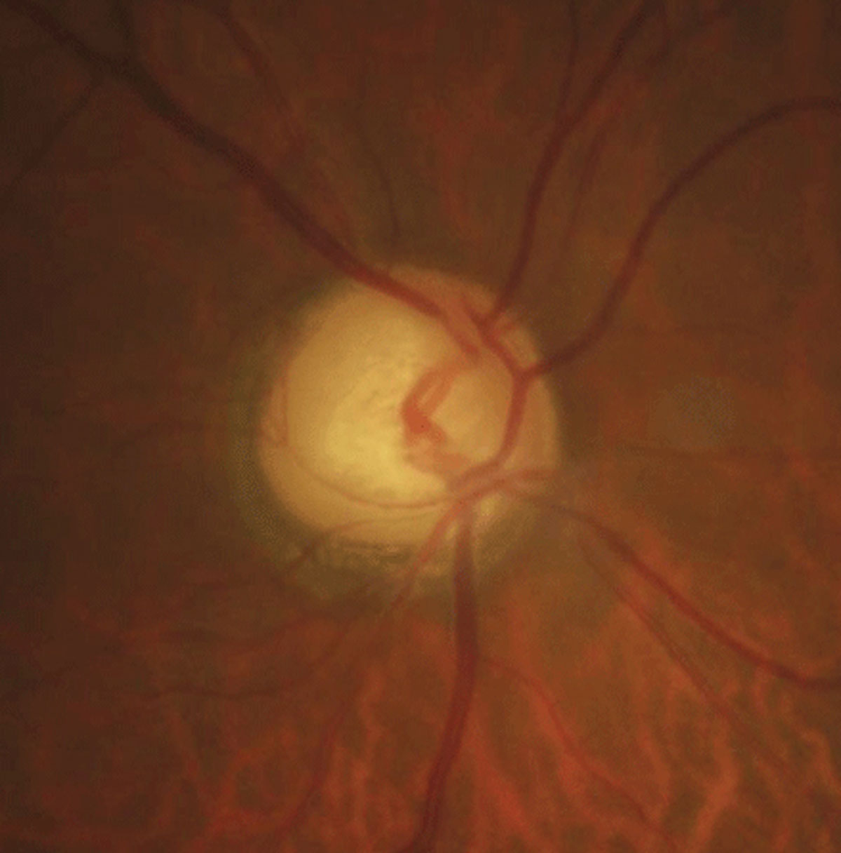 Optic disc crescent is much more common in those with high myopia, study shows. 